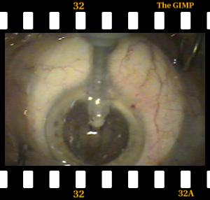 Facoemulsificazione