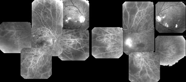 Fuorangiografia retinica