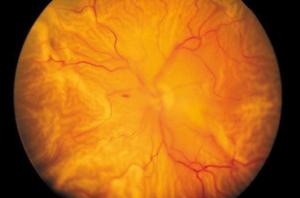 Distacco retinico