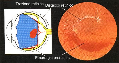 Distacco retinico trattivo