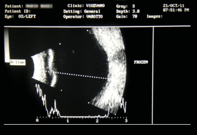 Tracciato B-scan