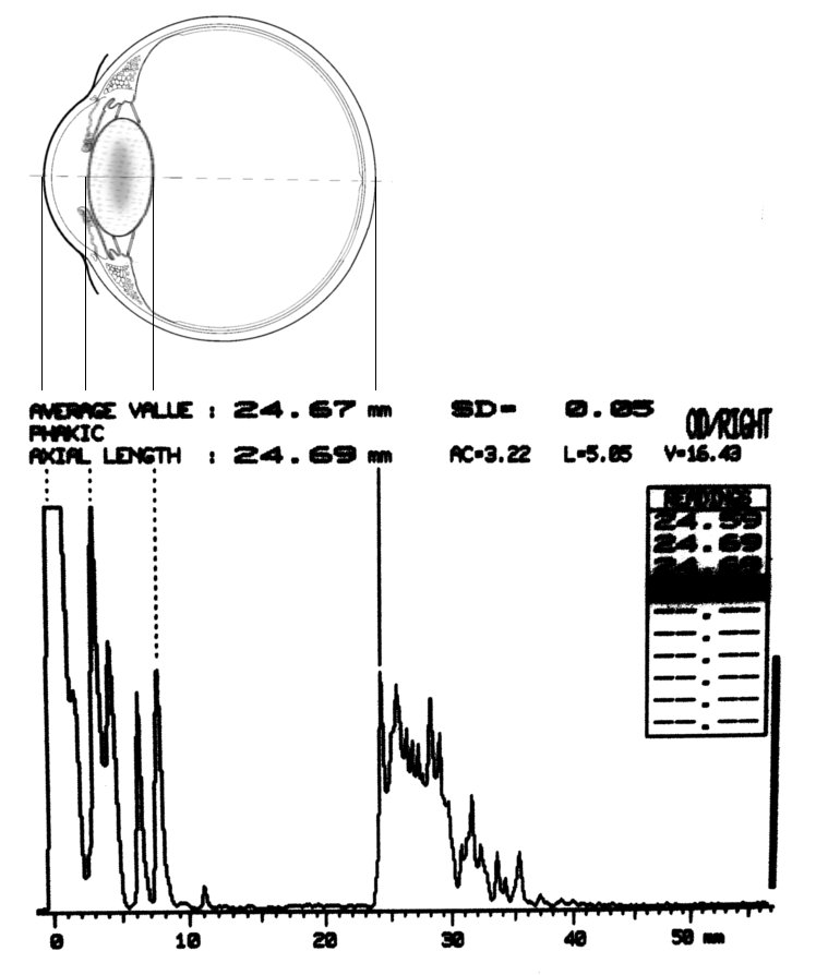 Schema ecografia A scan