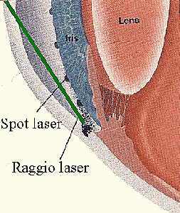 Trabeculoplastica laser