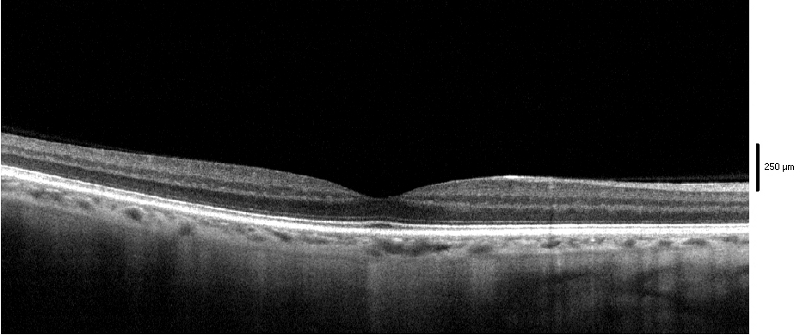 B scan macula normale
