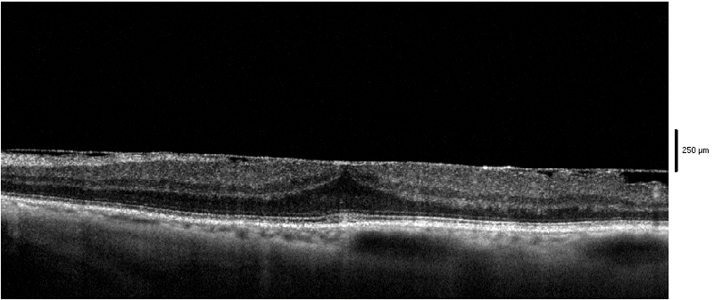 B-scan macula con membrana epiretinica