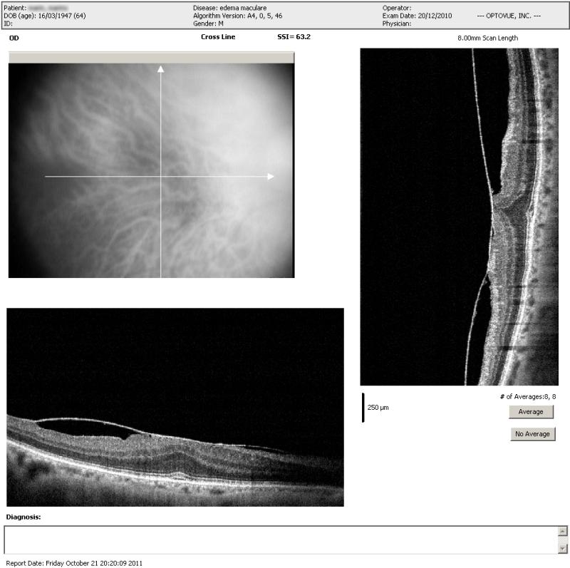 OCT membrana maculare epiretinica ed edema maculare