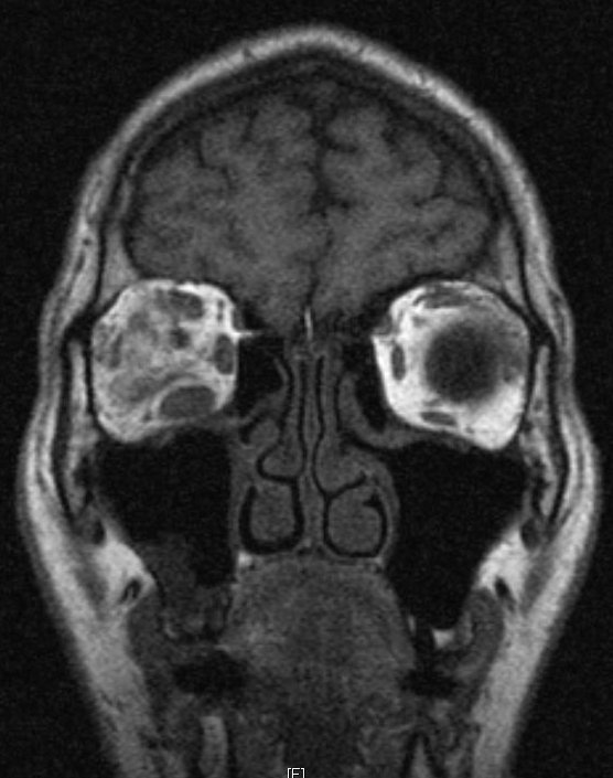 Rigonfiamento dei muscoli extraoculari