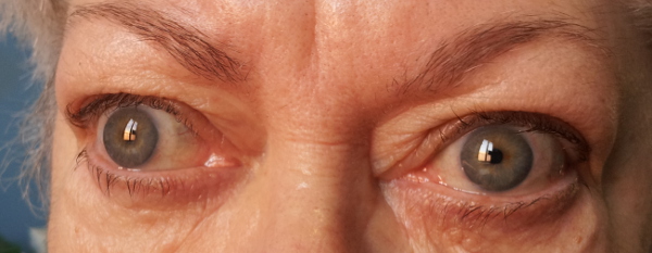 Retrazione palpebrale ed exotropia