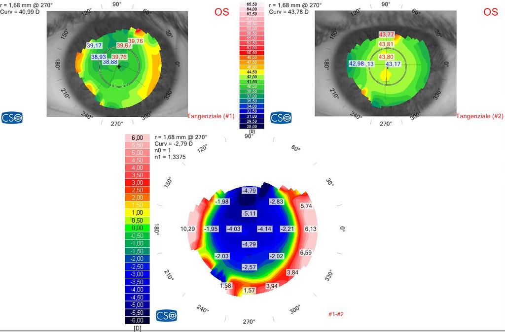 Mappa differenziale refrattiva tangenziale in una cornea sottoposta a correzione di miopia mediante laser ad eccimeri